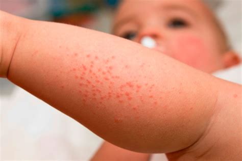 dermatitis atopica en niños-4